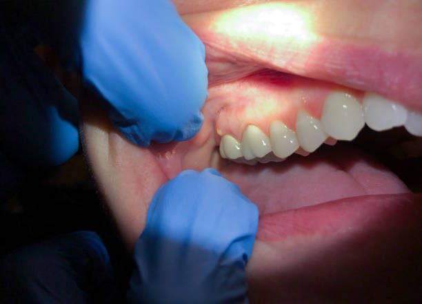 Best Emergency Denture Repair in Terrebonne, OR